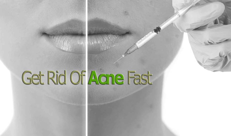 acne-injection Cortisone Shot Acne Injections Banner
