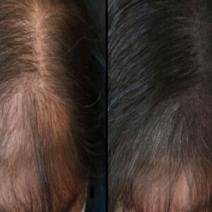Scalp Micropigmentation Deposit