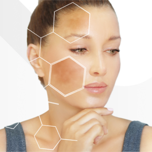 Photorejuvenation IPL Face & Neck