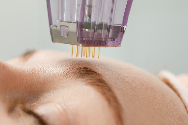 How Microneedling Can Improve the Appearance of Acne Scars?